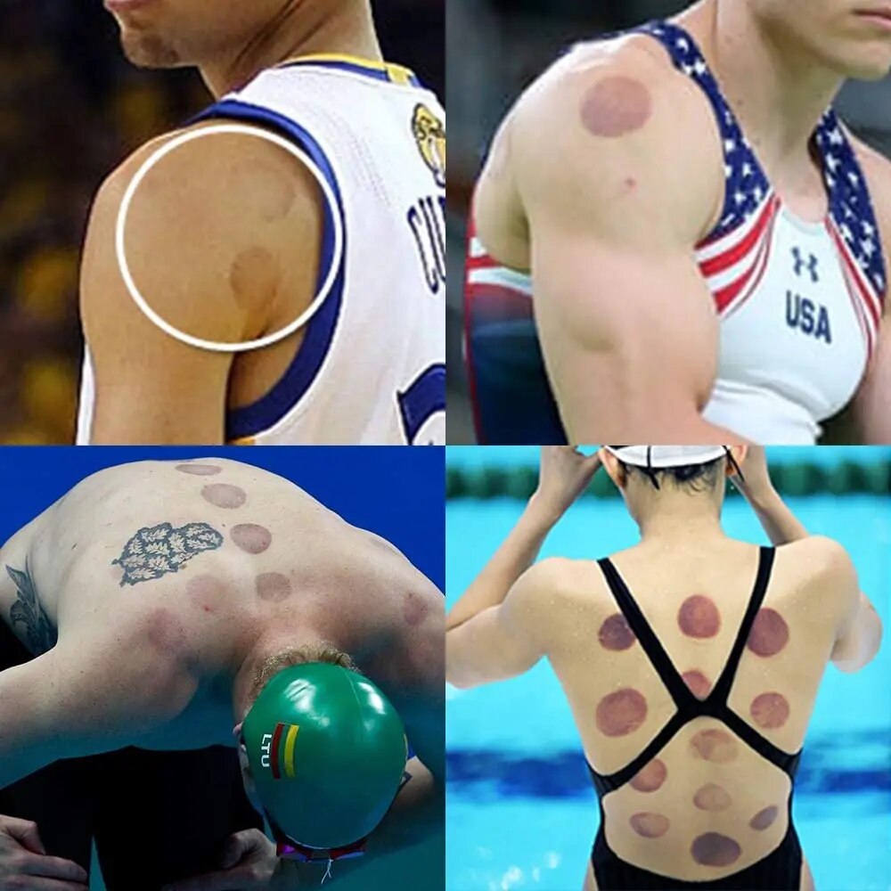 A Chinese Cupping Pain Relief Therapy